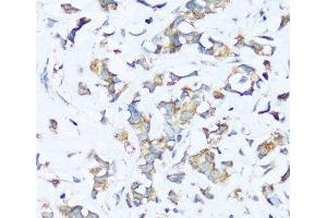 Immunohistochemistry of paraffin-embedded Human breast cancer using ATP5I Polyclonal Antibody at dilution of 1:100 (40x lens). (ATP5I anticorps)