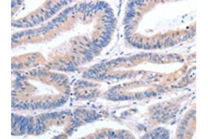 The image on the left is immunohistochemistry of paraffin-embedded Human colon cancer tissue using ABIN7190789(GFRA4 Antibody) at dilution 1/40, on the right is treated with synthetic peptide. (GFRA4 anticorps)