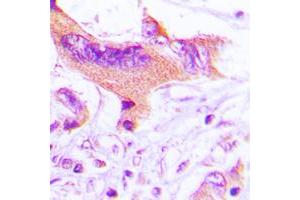 Immunohistochemical analysis of NIP1 staining in human lung cancer formalin fixed paraffin embedded tissue section.