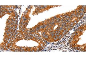 Immunohistochemistry of paraffin-embedded Human cervical cancer tissue using FGFR1 Polyclonal Antibody at dilution 1:60 (FGFR1 anticorps)
