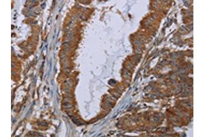 The image on the left is immunohistochemistry of paraffin-embedded Human esophagus cancer tissue using ABIN7129900(INSIG2 Antibody) at dilution 1/30, on the right is treated with fusion protein. (INSIG2 anticorps)