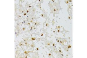 Immunohistochemistry of paraffin-embedded human brain astrocytoma using HNRNPA1 Antibody (ABIN5975570) at dilution of 1/100 (40x lens). (HNRNPA1 anticorps)