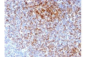 Formalin-fixed, paraffin-embedded human Follicular Lymphoma stained with Bcl-2 Rabbit Recombinant Monoclonal Antibody (BCL2/2210R).