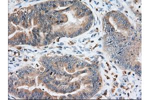 Immunohistochemical staining of paraffin-embedded Adenocarcinoma of Human colon tissue using anti-IGF2BP2 mouse monoclonal antibody. (IGF2BP2 anticorps)
