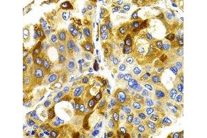 Immunohistochemistry of paraffin-embedded Human liver cancer using CDK20 Polyclonal Antibody at dilution of 1:100 (40x lens). (CCRK anticorps)