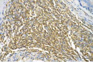 Immunohistochemistry was performed on paraffin-embedded human sigmoid colon carcinoma using CAP1 antibody (ABIN7797862), 1:200).