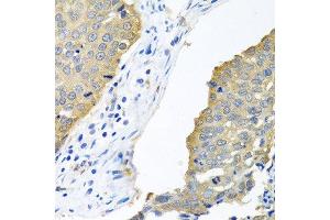 Immunohistochemistry of paraffin-embedded human lung cancer using EIF4E antibody.