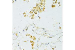 Immunohistochemistry of paraffin-embedded human lung cancer using SIRT2 antibody. (SIRT2 anticorps)