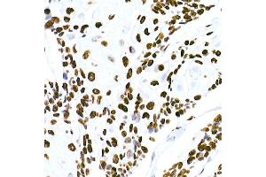 Immunohistochemistry of paraffin-embedded human esophageal cancer using HNRNPM Rabbit mAb (ABIN7267635) at dilution of 1:100 (40x lens).