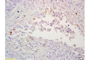 Formalin-fixed and paraffin embedded human lung carcinoma labeled with Rabbit Anti LRP/MVP Polyclonal Antibody, Unconjugated (ABIN671586) at 1:200 followed by conjugation to the secondary antibody and DAB staining (MVP anticorps  (AA 88-180))