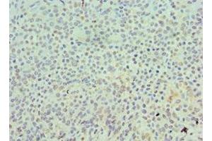Immunohistochemistry of paraffin-embedded human breast cancer using ABIN7168550 at dilution of 1:100 (SKP1 anticorps  (AA 1-163))