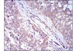 Immunohistochemical analysis of paraffin-embedded bladder cancer tissues using PLIN2 mouse mAb with DAB staining.