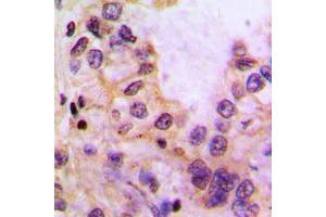 Immunohistochemical analysis of Cytochrome P450 39A1 staining in human liver cancer formalin fixed paraffin embedded tissue section.