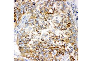 Anti- GCLC antibody, IHC(P) IHC(P): Human Lung Cancer Tissue (GCLC anticorps  (AA 437-637))