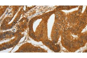 Immunohistochemistry of paraffin-embedded Human colon cancer tissue using RETNLB Polyclonal Antibody at dilution 1:40 (RETNLB anticorps)