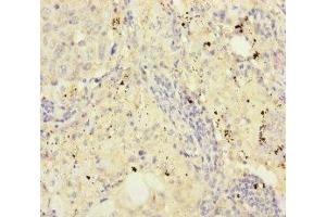 Immunohistochemistry of paraffin-embedded human lung cancer using ABIN7152960 at dilution of 1:100 (FKBPL anticorps  (AA 1-349))