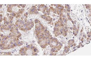 ABIN6279113 at 1/100 staining Human liver cancer tissue by IHC-P.