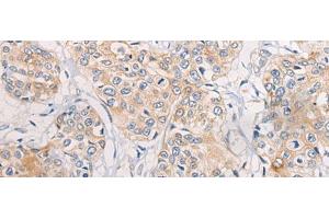 Immunohistochemistry of paraffin-embedded Human prost at e cancer tissue using CPD Polyclonal Antibody at dilution of 1:70(x200) (CPD anticorps)