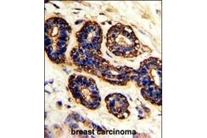 Formalin-fixed and paraffin-embedded human breast carcinoma with BEST2 Antibody (C-term), which was peroxidase-conjugated to the secondary antibody, followed by DAB staining. (Bestrophin 2 anticorps  (C-Term))