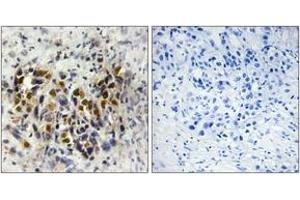 Immunohistochemistry analysis of paraffin-embedded human breast carcinoma tissue, using IRX3 Antibody. (IRX3 anticorps  (AA 271-320))