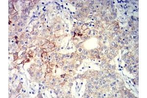 Immunohistochemical analysis of paraffin-embedded stomach cancer tissues using CD104 mouse mAb with DAB staining.