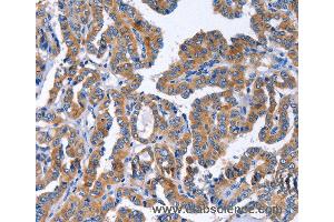 Immunohistochemistry of Human liver cancer using IGSF10 Polyclonal Antibody at dilution of 1:50 (IGSF10 anticorps)