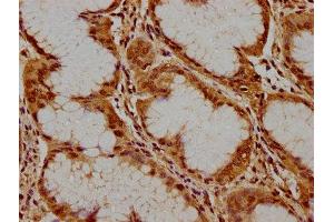 IHC image of ABIN7169084 diluted at 1:300 and staining in paraffin-embedded human stomach cancer performed on a Leica BondTM system. (PKN3 anticorps  (AA 1-252))
