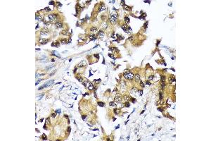 Immunohistochemistry of paraffin-embedded human lung cancer using Ube2N/Ubc13 Rabbit mAb (ABIN7271179) at dilution of 1:100 (40x lens). (UBE2N anticorps)