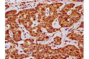 IHC image of ABIN7172525 diluted at 1:200 and staining in paraffin-embedded human liver cancer performed on a Leica BondTM system.