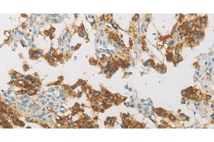 Immunohistochemistry of paraffin-embedded Human thyroid cancer using IDH3G Polyclonal Antibody at dilution of 1:30