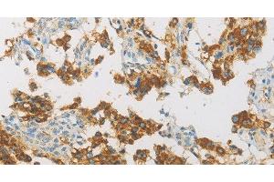 Immunohistochemistry of paraffin-embedded Human thyroid cancer using IDH3G Polyclonal Antibody at dilution of 1:30 (IDH3G anticorps)
