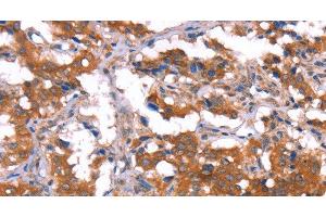 Immunohistochemistry of paraffin-embedded Human thyroid cancer tissue using HCAR2 Polyclonal Antibody at dilution 1:40 (HCAR2 anticorps)
