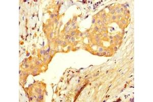 Immunohistochemistry of paraffin-embedded human breast cancer using ABIN7174485 at dilution of 1:100 (Ube2t anticorps  (AA 1-197))