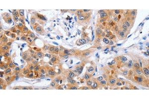 Immunohistochemistry of paraffin-embedded Human lung cancer using NCK1 Polyclonal Antibody at dilution of 1:30 (NCK1 anticorps)