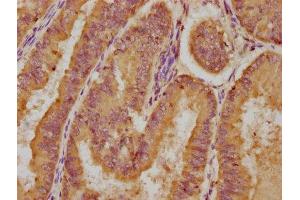 IHC image of ABIN7158748 diluted at 1:200 and staining in paraffin-embedded human endometrial cancer performed on a Leica BondTM system.