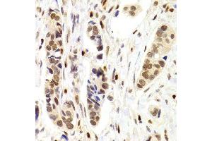 Immunohistochemistry of paraffin-embedded Human mammary cancer using NASP antibody at dilution of 1:100 (x400 lens). (NASP anticorps)