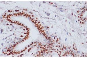 Immunohistochemistry of paraffin-embedded Human breast cancer using Acetyl-Histone H3-K9/K14/K18/K23/K27 Polyclonal Antibody at dilution of 1:100 (40x lens).