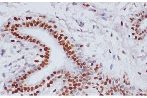 Immunohistochemistry of paraffin-embedded Human breast cancer using Acetyl-Histone H3-K9/K14/K18/K23/K27 Polyclonal Antibody at dilution of 1:100 (40x lens). (Histone 3 anticorps  (acLys9, acLys14, acLys18, acLys23, acLys27))