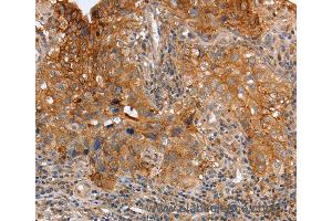 Immunohistochemistry of Human cervical cancer using PLAUR Polyclonal Antibody at dilution of 1:60 (PLAUR anticorps)