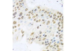 Immunohistochemistry of paraffin-embedded human lung cancer using ZBTB17 antibody (ABIN5974597) at dilution of 1/100 (40x lens). (ZBTB17 anticorps)