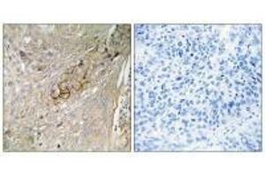 Immunohistochemistry analysis of paraffin-embedded human lung carcinoma tissue using SC6A6 antibody.