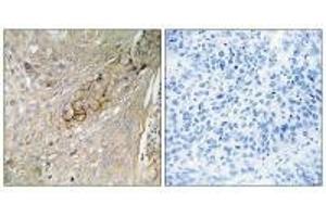 Immunohistochemistry analysis of paraffin-embedded human lung carcinoma tissue using SC6A6 antibody. (TAUT anticorps)