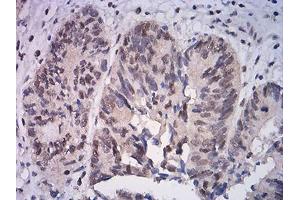 Immunohistochemical analysis of paraffin-embedded rectum cancer tissues using ATF4 mouse mAb with DAB staining.