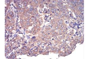 Immunohistochemical analysis of paraffin-embedded endometrial cancer tissues using CFHR5 mouse mAb with DAB staining.