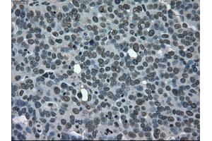 Immunohistochemical staining of paraffin-embedded Adenocarcinoma of ovary tissue using anti-CD4mouse monoclonal antibody. (CD4 anticorps)