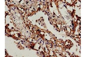 Immunocytochemistry analysis of human lung cancer using ABIN7145302 at dilution of 1:100