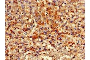 Immunohistochemistry of paraffin-embedded human liver cancer using ABIN7162982 at dilution of 1:100