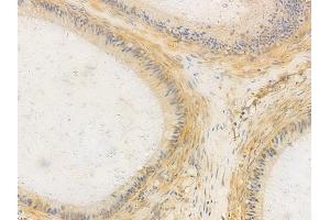 ABIN6265066 and ABIN6266633 at 1/100 staining human testicular cancer by IHC-P.