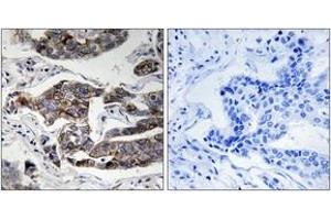 Immunohistochemistry analysis of paraffin-embedded human breast carcinoma, using Girdin (Phospho-Ser1417) Antibody. (Girdin anticorps  (pSer1417))