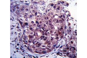 Estrogen Receptor antibody immunohistochemistry analysis in formalin fixed and paraffin embedded human breast carcinoma. (Estrogen Receptor alpha anticorps  (AA 246-273))